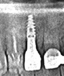 根管治療 vs. 歯科インプラント