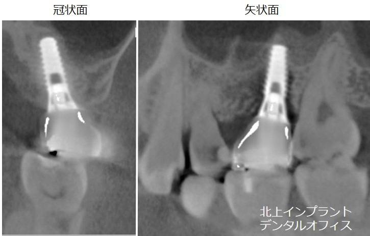 単冠のインプラント治療