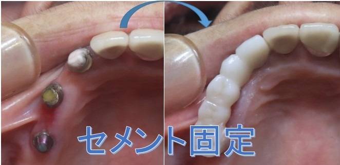 インプラント上部構造が「生涯、仮着」である深遠な理由