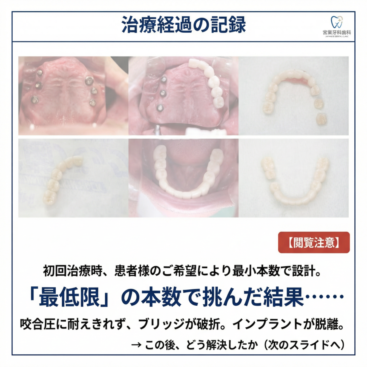 【全顎インプラント症例】「一生、自分の歯のように」を実現するための決断とプロセス