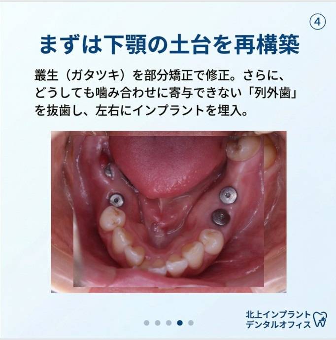 なぜ「インプラント」の前に「矯正」が必要だったのか