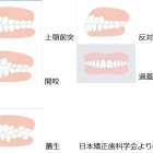 歯並びとインプラントの関係