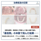 【全顎インプラント症例】「一生、自分の歯のように」を実現するための決断とプロセス