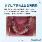 なぜ「インプラント」の前に「矯正」が必要だったのか